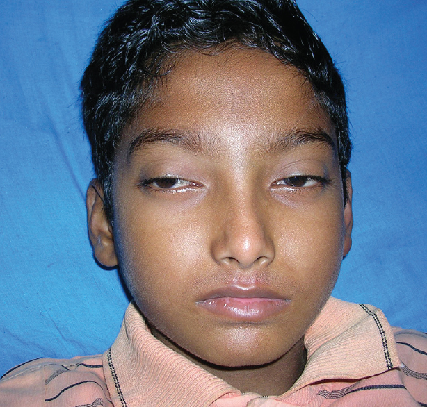 An 11-year-old male child with bilateral symmetrical ptosis