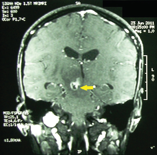 Magnetic resonance imaging of brain (T1-weighted image; contrast-enhanced) showing single ring-enhancing lesion (yellow arrow) in the dorsal part of the midbrain with significant perifocal edema in adjacent part of brainstem, right cerebellar peduncle, adjacent thalamocortical tract, and periventricular region