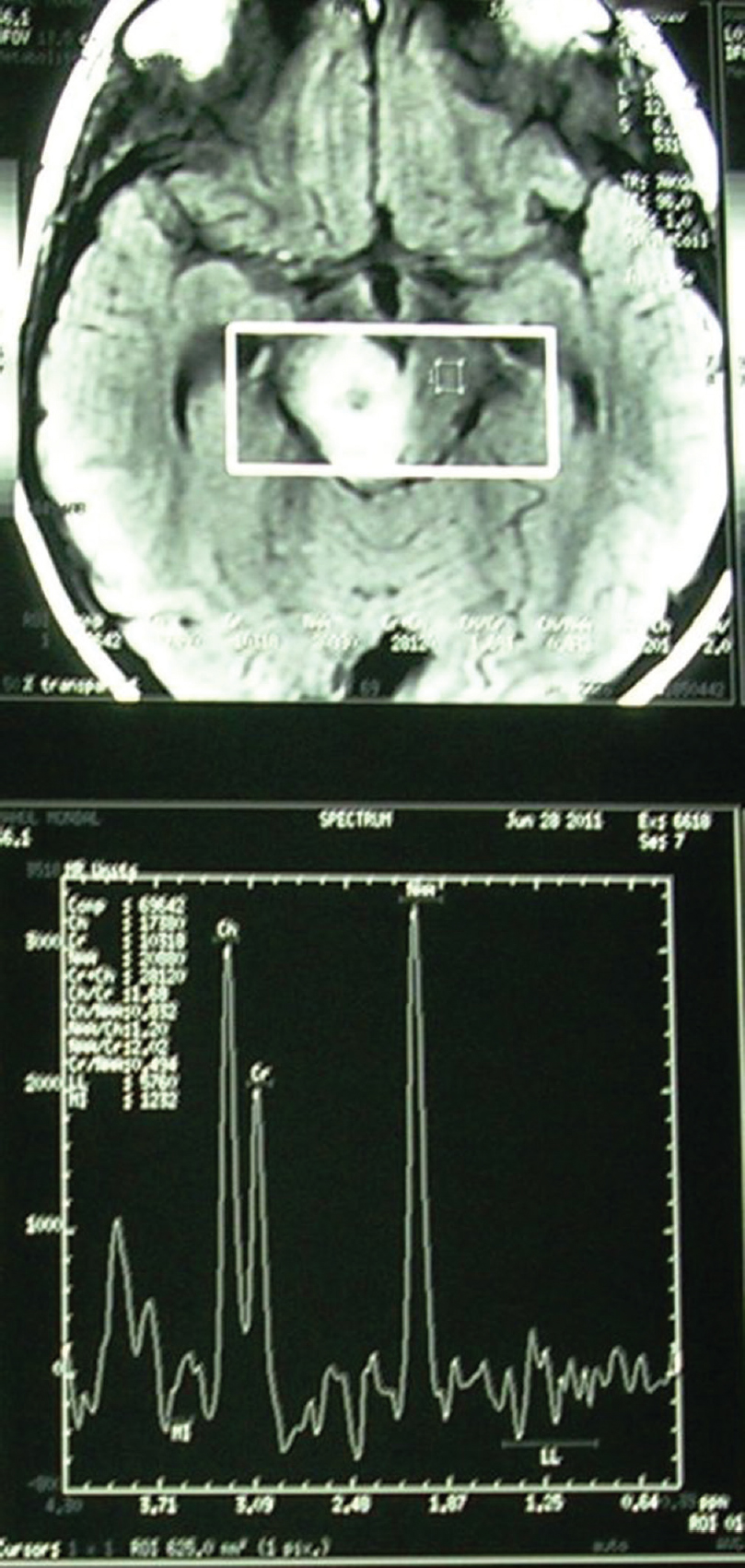 Magnetic resonance spectroscopy showing increased lipid peak, decreased N-acetylaspartate peak with increased Ch/Cr ratio, suggestive of tuberculoma