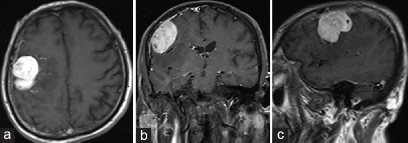 (a) Preoperative T1-weighted contrast-enhanced axial cranial magnetic resonance imaging showing a right frontoparietal mass lesion and perilesional edema. (b) Preoperative T1-weighted contrast-enhanced coronal cranial magnetic resonance imaging showing a right frontoparietal mass lesion and perilesional edema. (c) Preoperative T1-weighted contrast-enhanced sagittal cranial magnetic resonance imaging showing a right frontoparietal mass lesion and perilesional edema