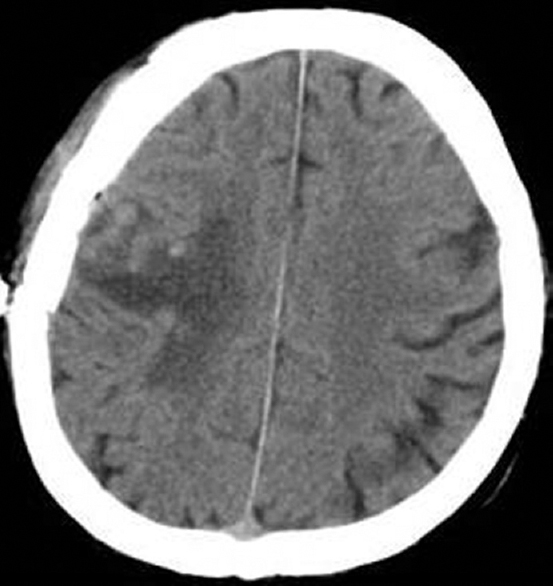 Postoperative axial cranial computed tomography image showing tumor removal with normal postoperative changes and persisting preexisting perilesional edema