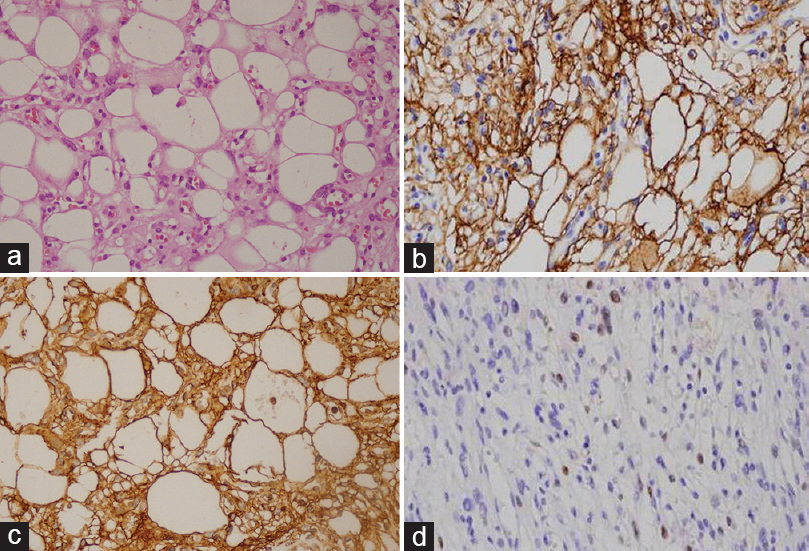 (a) Tumor tissue containing large cells seeming as fat-like proliferation with classic meningothelial neoplastic cells. Tumor cells have round nuclei and fat vacuoles in their cytoplasms (H and E, ×40). (b) Tumor tissue showing the expression of epithelial membrane antigen (EMA, ×40). (c) Tumor tissue showing positive staining with vimentin (Vimentin, ×40). (d) Tumor tissue showing the expression of progesterone receptor (PR, ×200)