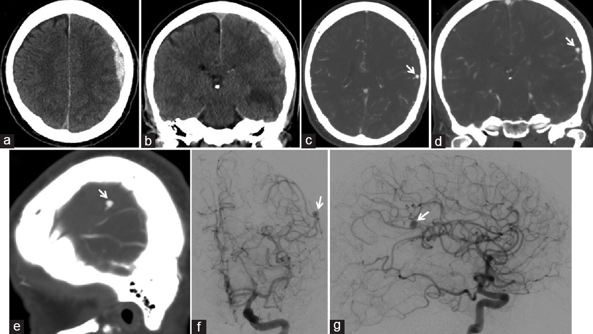 Preoperative brain computed tomography, (a) axial and (b) coronal views, shows an acute subdural hematoma of the left convexity, measuring 11 mm in maximal thickness, resulting in 3 mm of midline shift. Preoperative brain computed tomography angiography, (c) axial, (d) coronal, (e) and sagittal views, shows a ruptured 6 mm × 5 mm aneurysm (arrow) arising from the distal left middle cerebral artery. Preoperative cerebral angiography, (f) anteroposterior and (g) lateral views of a left computed tomography angiography injection, shows an aneurysm (arrow) arising from the distal left angular artery, favoring a mycotic aneurysm based on its location and morphology