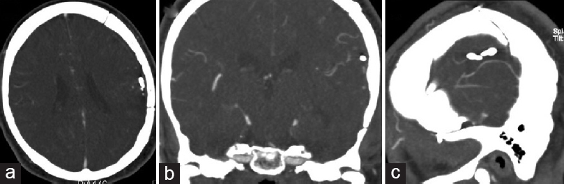 Postoperative brain computed tomography angiography performed 2 months after craniotomy for trapping of the mycotic aneurysm, (a) axial, (b) coronal, (c) and sagittal views, shows no evidence of a recurrent or new aneurysm