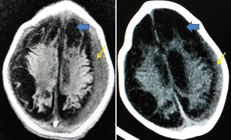 Axial noncontrast computed tomography scan of the brain reveals extra-axial subdural hematoma (thin arrows). Also noted are multiple hypodense cysts replacing the cortex (thick arrows)