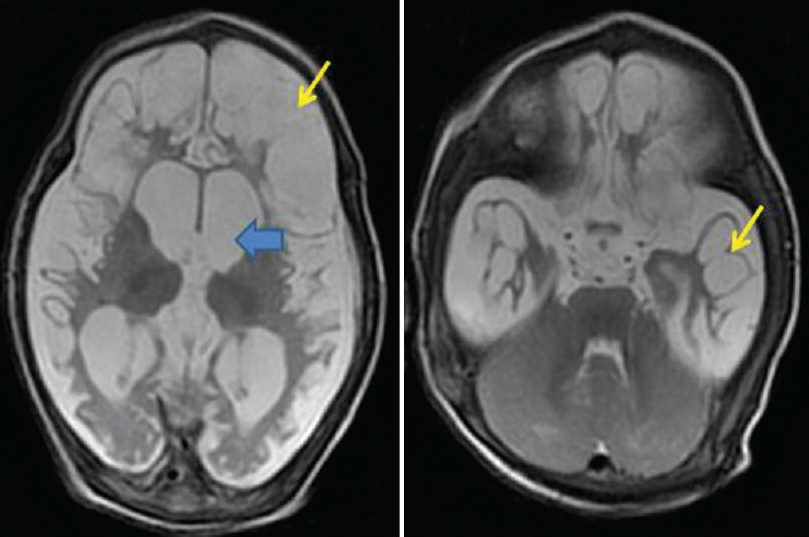 Axial T2-weighted magnetic resonance imaging images show multiple hyperintense cysts replacing the cerebral cortex bilaterally (thin arrows). Also noted are dilated ventricles secondary to volume loss (thick arrows). Note the sparing of the cerebellum