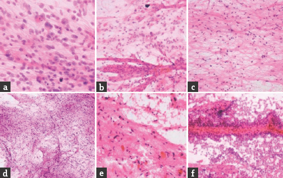 (a) High-grade astrocytoma: sheets of cells having large irregular pleomorphic nuclei; mitotic figure ares seen; (H and E, ×400). (b) Glioblastoma: thick-walled blood vessels; (H and E, ×400). (c) Low-grade astrocytoma – increase in cellularity with mild nuclear pleomorphism; (H and E, ×400). (d) Pilocytic astrocytoma with loose and cellular area; (H and E, ×100). (e) Pilocytic astrocytoma demonstrating Eosinophilic granular bodies; (H and E, ×400). (f) Ependymoma: cells are arranged in small papillae around blood vessel. More loosely adherent cells are smeared away from vessels; (H and E, ×400)