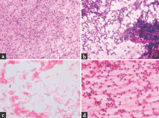 (a) Oligodendroglioma showing finely branching capillary network; (H and E, ×400). (b) Cellular smears of lymphoma showing isolated large round cells with scanty cytoplasm. Nucleoli are prominent; (H and E, ×400). (c) Epidermoid cyst showing flakes of keratinous material; (H and E, ×400). (d) Smears showing inflammatory cell infiltrate and macrophages; (H and E, ×400)