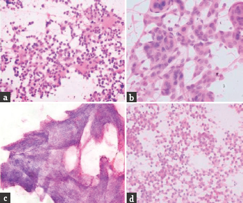 (a) Medulloblastoma showing neoplastic cells in sheets and rosettes are present; (H and E, ×400). (b) Meningioma showing whorled pattern of meningothelial cells; (H and E, ×400). (c) Schwannoma showing interlacing fascicles of smeared Antoni A tissue consisting of tightly packed, elongated spindle-shaped tumor cells; (H and E, ×100). (d) Pituitary adenoma showing sheets of round cells having moderate amount of cytoplasm and at places arranged in the glandular pattern; (H and E, ×400)