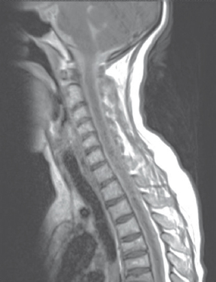 Extensive spinal arachnoiditis in contrast sagittal images