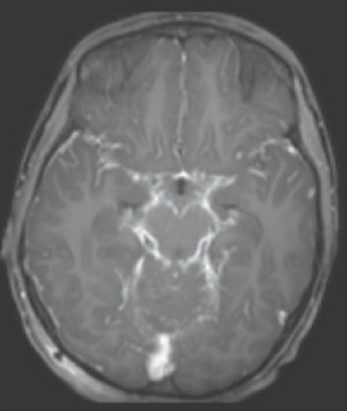 T1 axial contrast images show extensive basal exudatesn