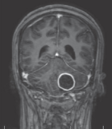 Histopathology confirmed tuberculoma in T1 contrast images