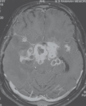 T1 axial post contrast multiple tuberculomas in basal cisterns