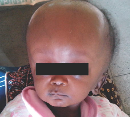 Typical hydrocephalus