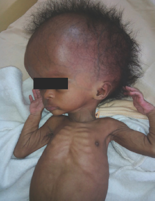 Neglected congenital hydrocephalus