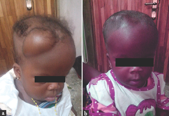 (a) Subgaleal pouch following ventriculosubgalial shunt. (b) Postconversion of ventriculosubgaleal shunt to ventriculoperitoneal shunt