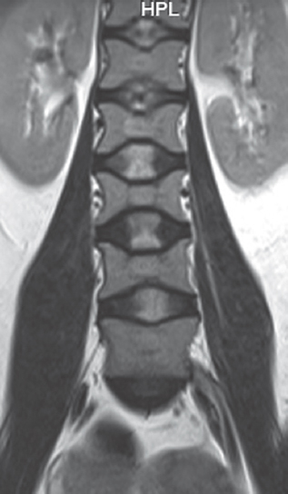 Coronal magnetic resonance slice showing “H-shaped” lumbar vertebrae (Lincoln log vertebra) with central end plate depression consequent to infarction