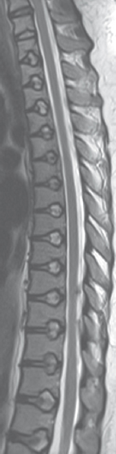 Sagittal magnetic resonance slice (T2 sequences) showing multilevel bulging of intervertebral discs into the vertebral body