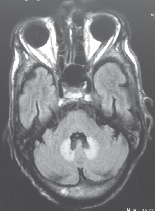 Symmetrical dentate hyperintensities best seen on fluid attenuation inversion recovery images