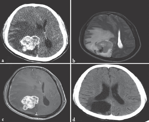 (a) Cranial computer tomography (postcontrast) revealing a right parieto-occipital mass lesion, enhancing heterogeneously on contrast with significant perilesional edema. (b and c) Magnetic resonance imaging of the brain (plain and contrast) revealing a lesion, isointense to hyperintense on T2-weighted (b) with heterogeneous enhancement on contrast measuring 5.2 cm × 4.4 cm × 4.2 cm (c). (d) Computed tomography (postcontrast) 18 months no residual lesion