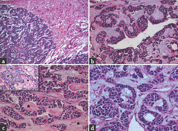 Histopathology reveals a cellular tumor with sharp circumscription from the surrounding brain parenchyma (a). The tumor cells are disposed in tubular and cribriform patterns (b-d) with hyaline (c) material within and around the tumor cells (asterisk, c), highlighted by periodic acid–Schiff stain (c, inset). Focally, bluish myxoid material was seen within the lumen (d) (a: H and E ×10, b-d: H and E ×20, c, inset: Periodic acid–Schiff ×20]