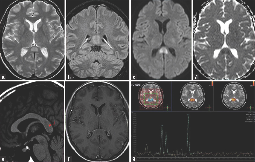 MRI shows the lesion of 15 mm in the posterior portion of the corpus callosum on T2-immaging (a). Flair (b). diffusion weighted imaging (c and d). T1-immaging (e and f). and MRI-spectroscopy (g)