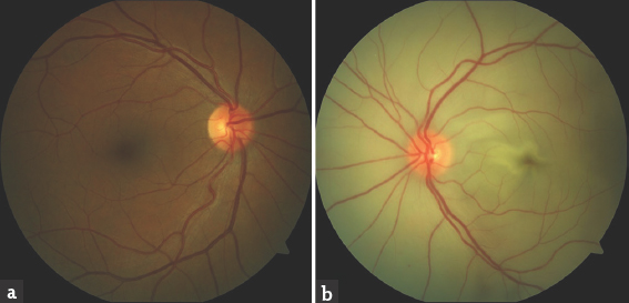 Fundoscopic views of both eyes performed immediately after the detection of vision loss. Fundoscopic view of the right eye (a) reveals normal findings; however, fundoscopic view of the left eye (b) reveals total retinal paleness