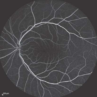 Fundus fluorescein angiography of the left eye performed immediately after the detection of vision loss reveals that the filling of the left retinal artery and vein is normal (15th s)