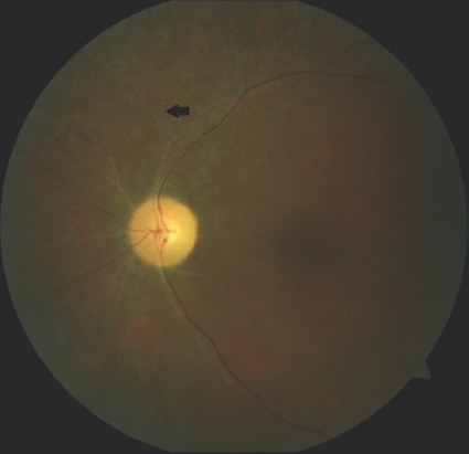 Fundoscopic view of the left eye performed at the 4th week of the vision loss reveals vascular attenuation and left retinal atrophy indicated in black arrow