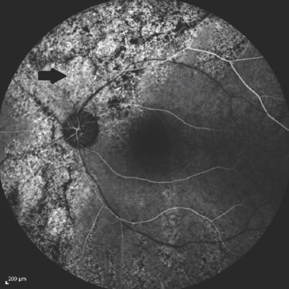 Fundus fluorescein angiography of the left eye performed at the 4th week of vision loss reveals thinned vascular structures and their delayed filling. Black arrow indicates hypo-fluorescent area secondary to retinal atrophy on the left optic disc (14th s)