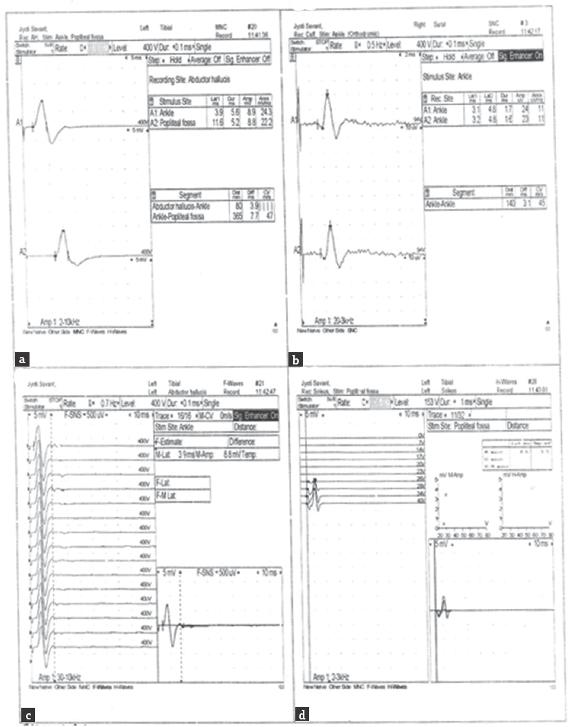 Nerve conduction study graph (Day 2 of illness) (a) left tibial CMAP (b) right sural SNAP (c) left tibial F wave (d) left solecus H reflex