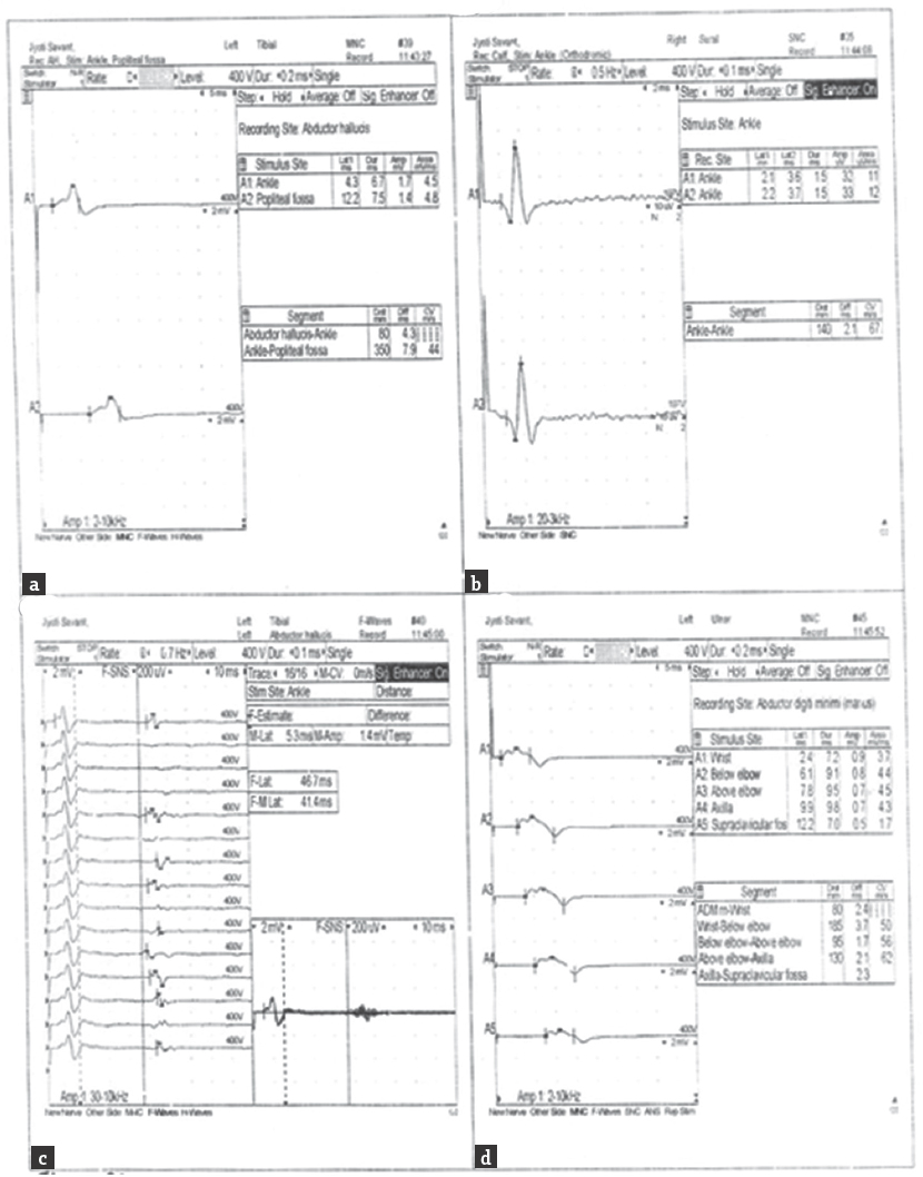 Nerve conduction study graph (Day 11th of illness) (a) left tibial CMAP (b) right sural SNAP (c) left tibial F wave (d) left ulnar CMAP