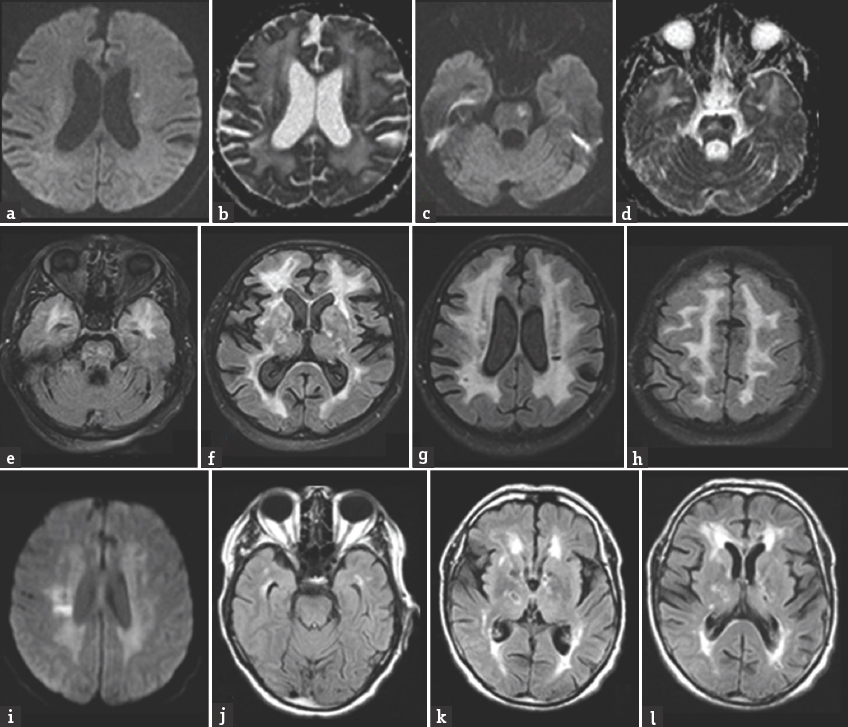 Magnetic resonance imaging of case 1 showing acute lacunar infarcts located in the left corona radiata and the anterolateral part of the mid-pons (a-d). Other images of case 1 showing coalescing white matter hyperintensities involving the temporal poles and the external capsules heavily along with multiple chronic lacunes (e-h). Magnetic resonance imaging of case 2 showing acute lacune along with advanced white matter disease and chronic lacunes (i-l)