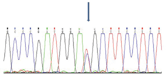 Chromatograms showing sequencing profile of the patient. Arrow shows the mutation site