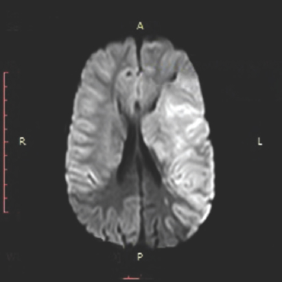 Magnetic resonance imaging with diffusion-weighted imaging showing large acute infarcts in left middle cerebral artery territory involving left basal ganglia, including insula, left temporal lobe, left parietal lobe and left posterior frontal lobe with effacement of underlying sulci, and mild contralateral midline shift