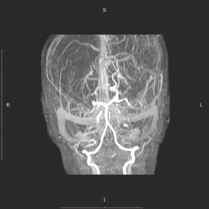 Magnetic resonance angiography showing marked irregular narrowing of supraclinoid portions of bilateral internal carotid arteries and bilateral M1 middle cerebral arteries with multiple collaterals, suggestive of moyamoya disease