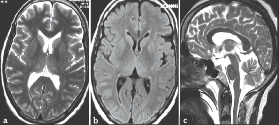 (a and b) Axial T2 and fluid-attenuated inversion recovery magnetic resonance images showing normal gray and white matter, basal ganglia, and thalami, (c) sagittal T2 image showing normal signal intensity in corpus callosum