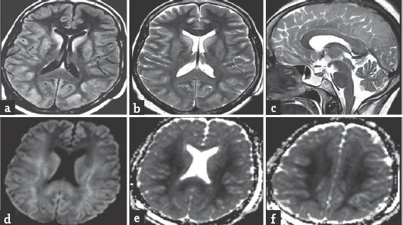 (a and b) Axial fluid attenuated inversion recovery and T2-weighted magnetic resonance images during follow-up showing gyriform abnormal hyperintensity sparing frontal lobe and basal ganglia, subtle T2/fluid-attenuated inversion recovery hyperintensity of white matter, (c) sagittal T2-weighted image showing abnormal T2 hyperintensity of corpus callosum, (d-f) axial diffusion-weighted imaging and apparent diffusion coefficient images showing diffusion restriction