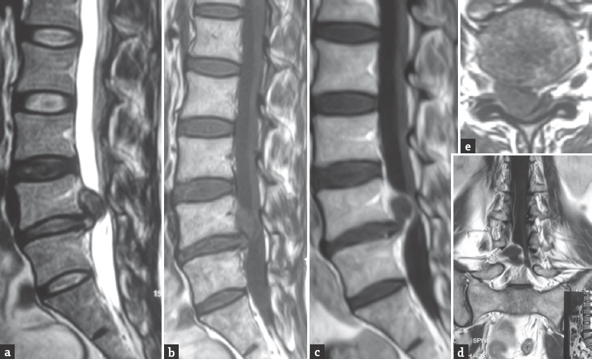 Initial magnetic resonance imaging sequences showing a large extruded L4-L5 and cranially migrated intervertebral disc on T2 sagittal (a), T1 sagittal (b), and T1 axial (e) sections. There is contrast enhancement at the periphery suggestive of inflammation as seen on postcontrast T1 sagittal (c) and T1 coronal (d) sections