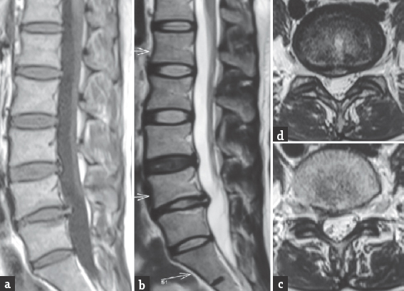 Repeat magnetic resonance imaging sequences after 7 months showing complete absorption of the extruded fragment with restitution of the normal shape of the thecal sac on T1 sagittal (a), T2 sagittal (b), and T2 axial images (c and d). A small residual disc bulge is seen which is not causing any symptom