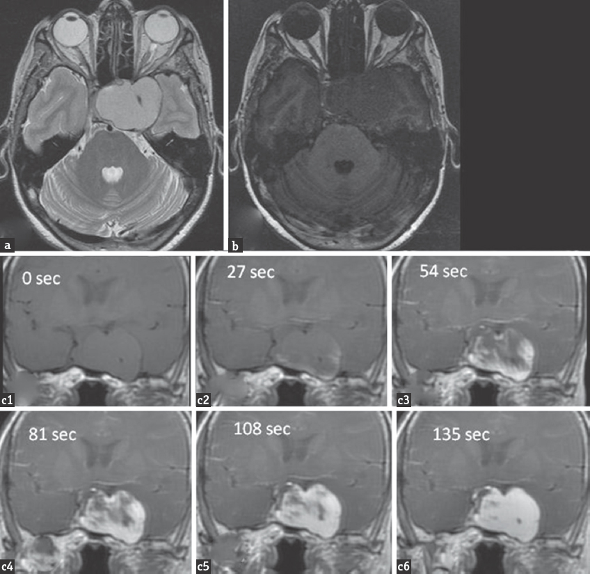 (a) Axial T2-weighted magnetic resonance imaging showing well-defined homogeneously hyperintense lesion in the suprasellar and left parasellar region with encasement of the left cavernous internal carotid artery. The lesion appears mildly hypointense on T1-weighted image (b). Dynamic contrast-enhanced imaging in coronal plane obtained in 6 phases at an interval of 27 s showing progressive filling in of the lesion and intense enhancement (c1-c6)