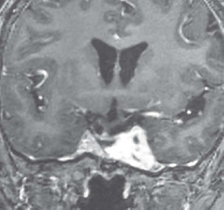 Follow-up imaging 4 months after radiotherapy. Postcontrast coronal T1-weighted image showing significant reduction in size of the lesion