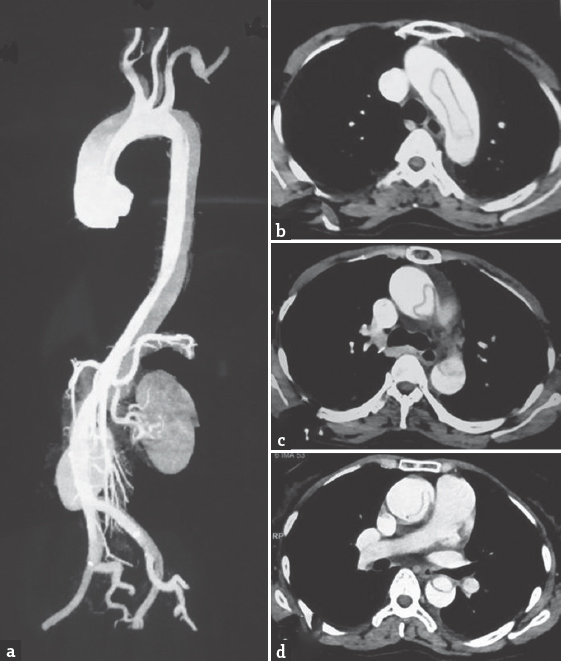 Computed tomography angiogram of the aorta. (a) Dissection of the aorta from the root involving carotids, renal artery up to iliac vessels. (b) True lumen inside the arch of the aorta. (c) Sausage-shaped true lumen in descending aorta. (d) Further reduction in the size of true lumen