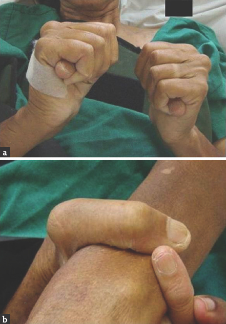 Clinical features of Marfan syndrome. (a) Thumb sign. (b) Wrist sign