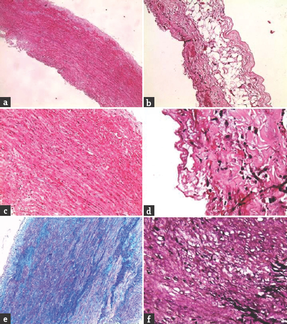 Histopathology of the dissected aorta. (a) Normal vessel wall. (b) Periadventitial adipose tissue. (c) Vessel wall showing mucoid material. (d) Inflammatory cells. (e) Alcian blue/periodic acid–Schiff stain showing mucoid material. (f) Verhoeff's-Van Gieson showing loss of elastic laminae (in black)