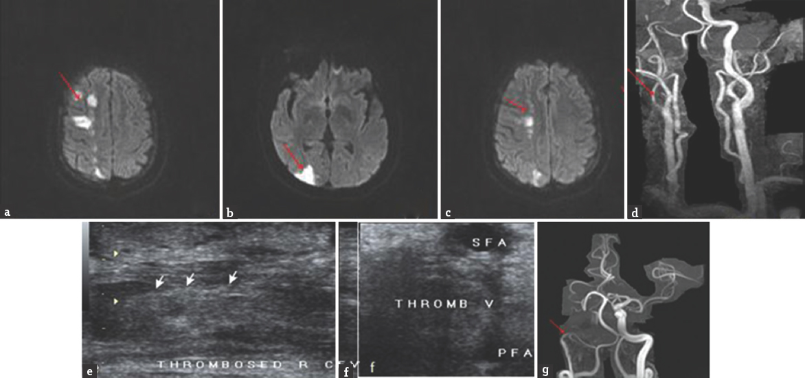 Magnetic resonance imaging brain diffusion-weighted imaging (a), (b and c) showing diffusion restriction in right anterior cerebral artery/middle cerebral artery and middle cerebral artery/posterior cerebral artery borderzone territory (red arrow); magnetic resonance angiography neck vessels (d) and circle of Willis (g) showing decreased flow in the right internal carotid artery from its origin (red arrow); Duplex ultrasonography(e and f) showing thrombus in the right femoral vein