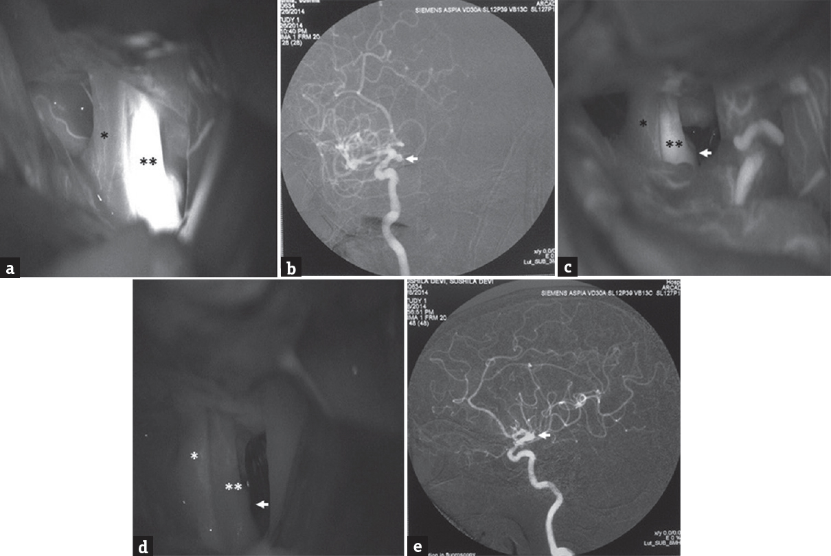 (Case 1): (a) Intraoperative indocyanine green videoangiography showing the right optic nerve (*), right internal carotid artery (**), and internal carotid artery-posterior communicating artery junction aneurysm before applying the clip during the first surgery; (b) postoperative digital subtraction angiography, oblique view, and showing the remnant of body and neck of aneurysm at right internal carotid artery-posterior communicating artery junction (arrowhead) after first surgery; (c) intraoperative indocyanine green videoangiography showing the right optic nerve (*), right internal carotid artery (**), and internal carotid artery-posterior communicating artery junction aneurysm remnant (arrowhead) single aneurysm clip during the second surgery; (d) delayed phase of intraoperative indocyanine green videoangiography showing the right optic nerve (*), right internal carotid artery (**), and internal carotid artery-posterior communicating artery junction aneurysm showing no aneurysm remnant (arrowhead) after the adjustment of clip with an additional clip placement during the second surgery; (e) postoperative digital subtraction angiography, lateral view, showing complete obliteration of aneurysm at the right internal carotid artery-posterior communicating artery junction (arrowhead) after the second surgery