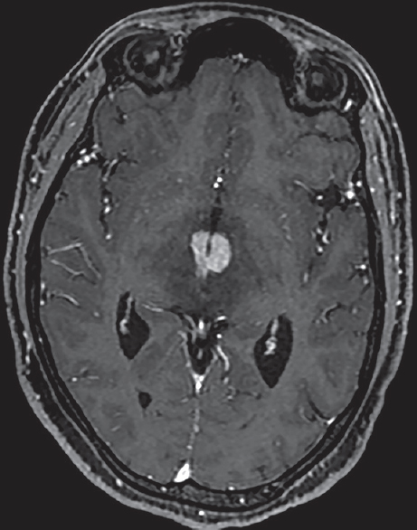 Axial T1-weighted contrast image showing enhancing foci in thalami, periventricular region of the third ventricle, and periaqueductal region