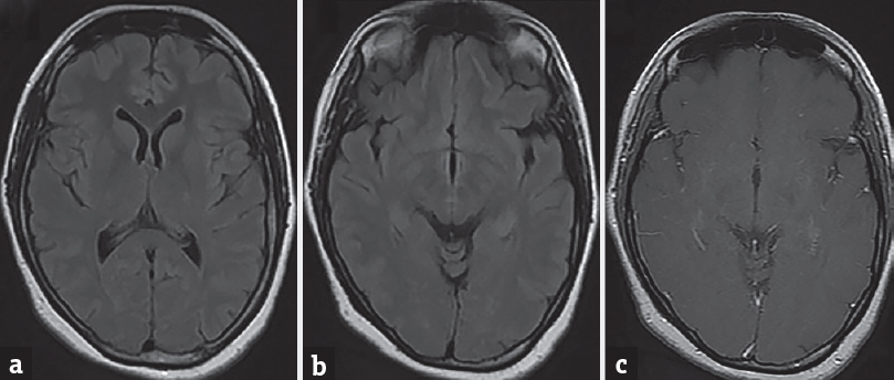 Axial fluid-attenuated inversion recovery (a and b) and contrast (c) showing complete resolution of lesion