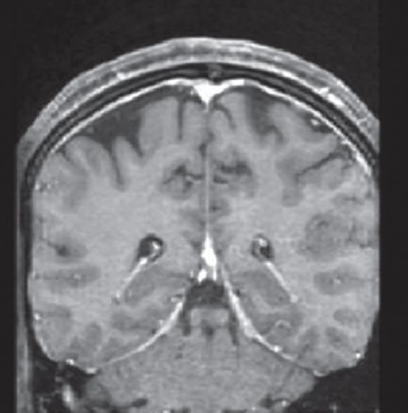 Coronal section of contrast-enhanced magnetic resonance imaging of brain showing pachymeningeal enhancement. The enhancement iuniform without a hypointense streak between adjacent folds of falx cerebri, indicative of secondary hypertrophic cranial pachymeningitis